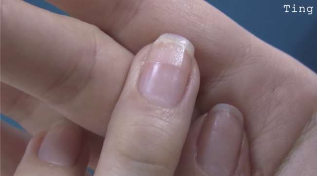 指甲裂开了该怎么办?教你用一个家里都有的"东西"轻松